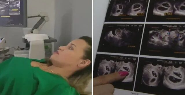Mãe se surpreende ao descobrir gravidez de quadrigêmeos durante ultrassom: ‘Foi um susto’