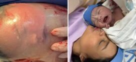 Bebê nasce empelicado em hospital de Goiás; vídeo