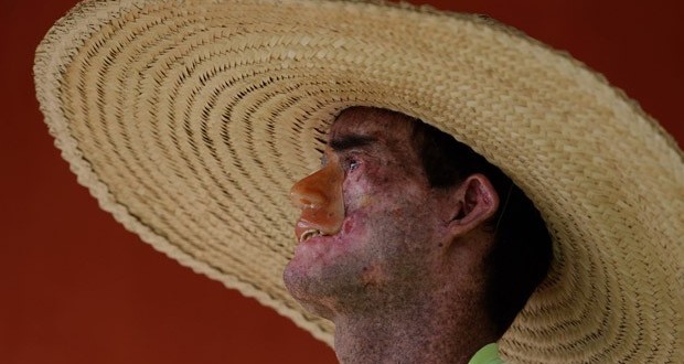 Povoado em Goiás tem a maior taxa mundial de doença rara de pele