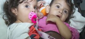 Siamesas de São Paulo unidas pelo abdômen e bacia são internadas para cirurgia de separação em Goiânia
