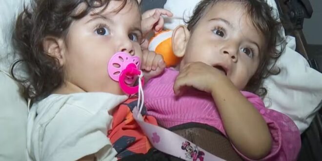 Siamesas de São Paulo unidas pelo abdômen e bacia são internadas para cirurgia de separação em Goiânia
