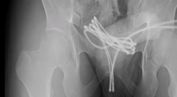 Jovem passa por cirurgia após introduzir cabo USB no pênis; veja foto