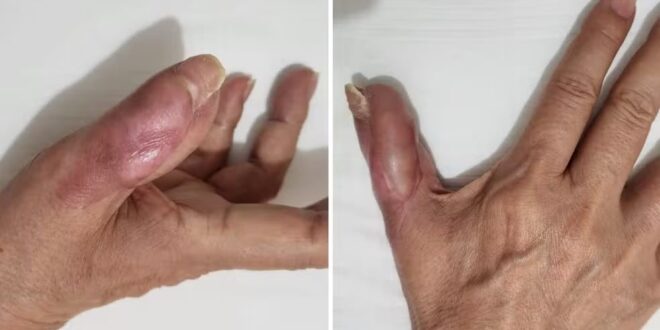Mulher perde parte do dedo após fazer as unhas em salão e ter infecção, diz família