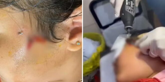 Criança fica com anzol preso no rosto durante pescaria em Luziânia