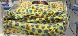 Bebês siameses que nasceram unidos pelo abdômen morrem em Goiânia