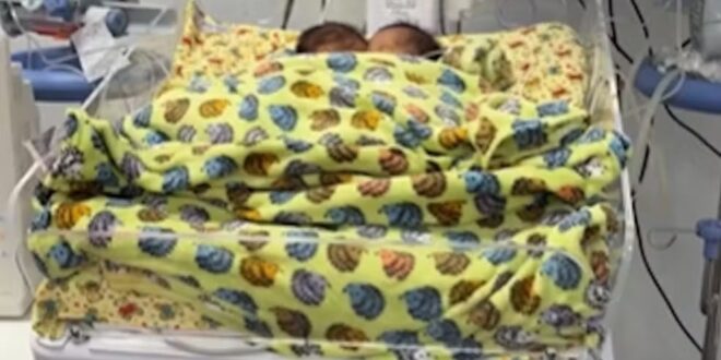 Bebês siameses que nasceram unidos pelo abdômen morrem em Goiânia